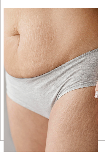 Flacidez na barriga após o parto